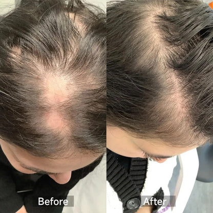 FolliSkin Laser Hair Growth Cap